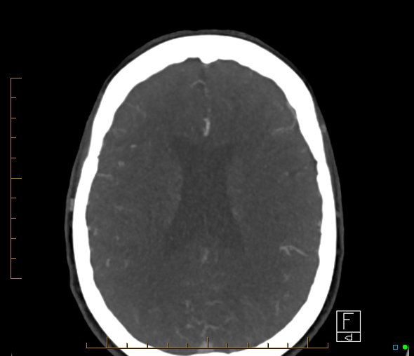 Brachiocephalic trunk stenosis (Radiopaedia 87242-103519 A 26).jpg