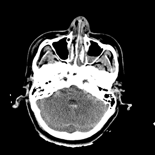 File:Brain contusions, internal carotid artery dissection and base of skull fracture (Radiopaedia 34089-35339 Axial non-contrast 21).png