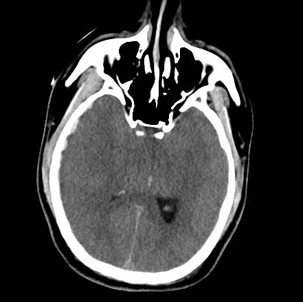 File:Brain death after motor vehicle collision (Radiopaedia 88470-105114 Axial 5).png