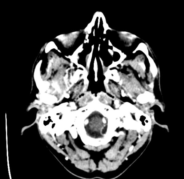 File:Brain metastases from lung cancer (Radiopaedia 24480-24781 Axial C+ delayed 1).jpg