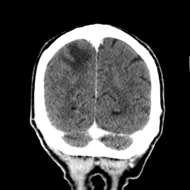 Brain metastases from lung cancer (Radiopaedia 27849-28092 Coronal C+ delayed 57).jpg