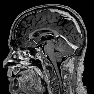 Brain metastases from lung cancer (Radiopaedia 83839-99028 Sagittal T1 C+ 33).jpg