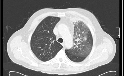 Brain metastases from squamocellular lung cancer (Radiopaedia 56515-63219 Axial lung window 23).jpg