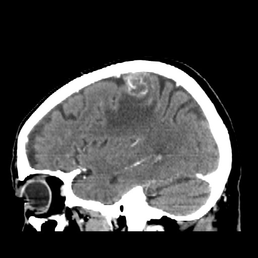 Brain metastasis (Radiopaedia 42617-45760 D 41).jpg
