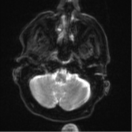 Brain metastasis (lung cancer) (Radiopaedia 48289-53179 Axial DWI 4).png