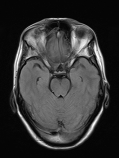 File:Brain metastasis as initial presentation of non-small cell lung cancer (Radiopaedia 65122-74126 Axial FLAIR 8).jpg