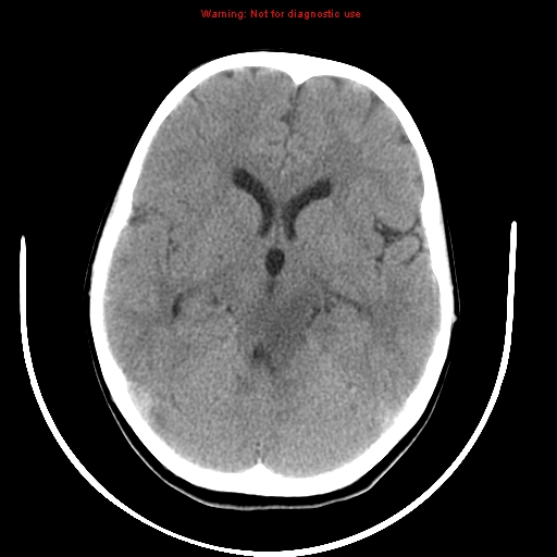 File:Brainstem glioma (Radiopaedia 9444-10123 non-contrast 9).jpg