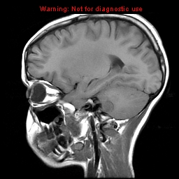 File:Brainstem glioma (Radiopaedia 9444-10124 Sagittal T1 9).jpg