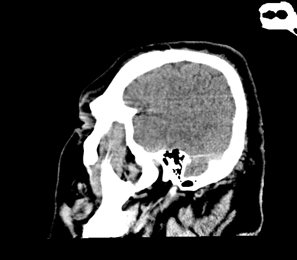 Brainstem hemorrhage (Radiopaedia 81294-94976 C 9).jpg