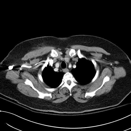Breast carcinoma with pathological hip fracture (Radiopaedia 60314-67974 A 10).jpg