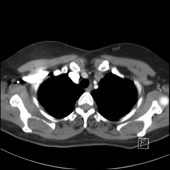 File:Breast metastases from renal cell cancer (Radiopaedia 79220-92225 A 18).jpg