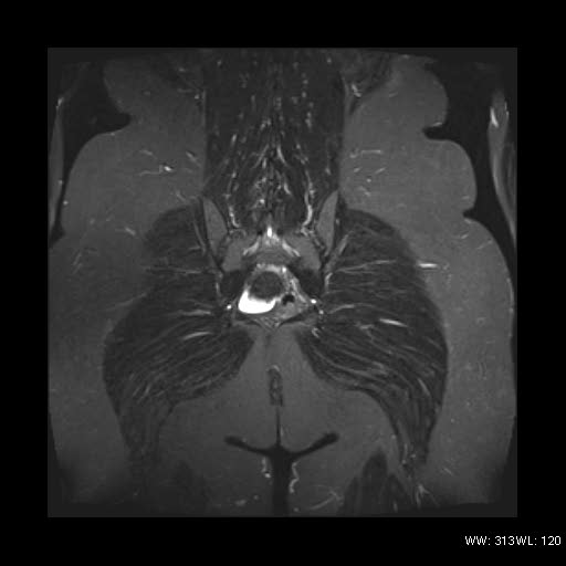 File:Broad ligament fibroid (Radiopaedia 49135-54241 Coronal STIR 23).jpg