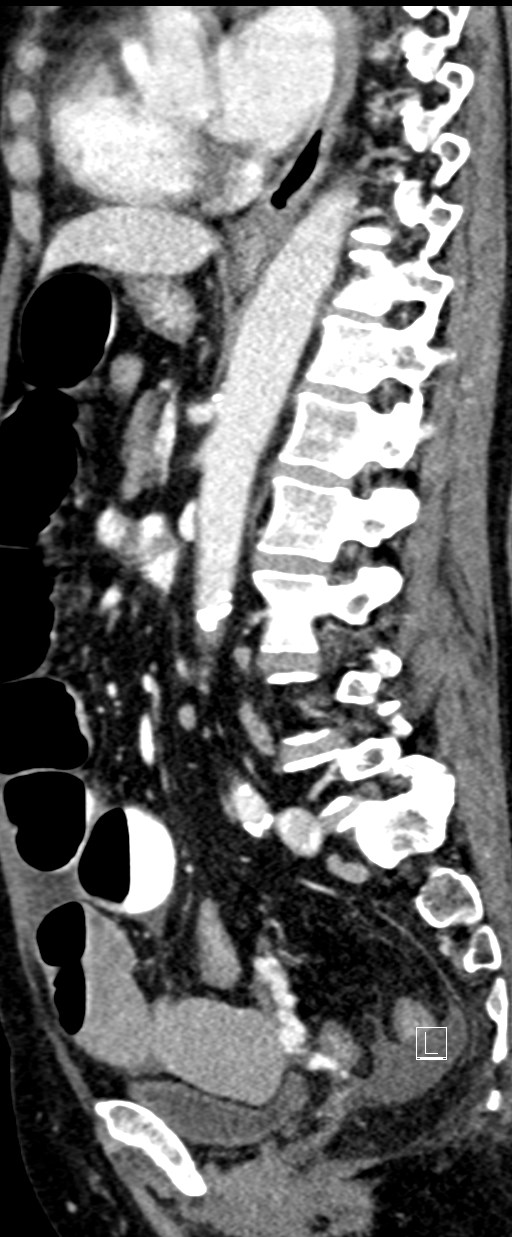 Broad ligament hernia (Radiopaedia 84802-100276 C 33).jpg