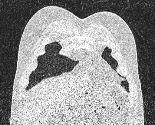 Bronchial atresia (Radiopaedia 58271-65417 Coronal lung window 5).jpg