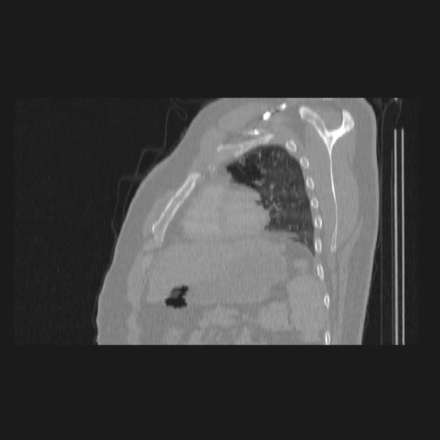 Bronchial atresia (Radiopaedia 60685-68439 Sagittal lung window 70).jpg