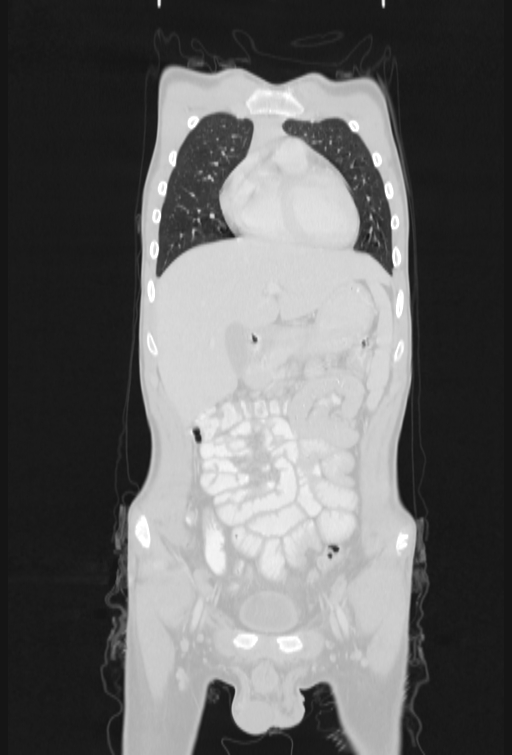 Bronchial carcinoid tumor (Radiopaedia 57187-64090 Coronal lung window 22).jpg