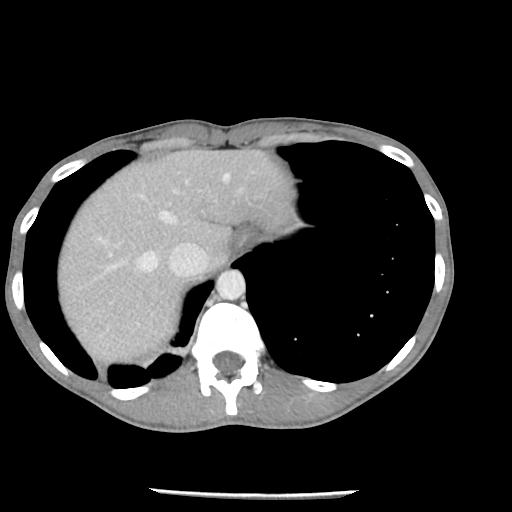 Bronchial carcinoid tumor causing right lower lobe collapse (Radiopaedia 83495-98594 A 47).jpg