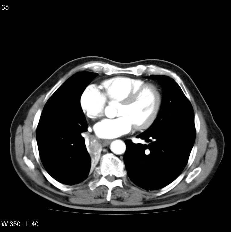 Bronchial carcinoid tumor with right lower lobe collapse (Radiopaedia 29060-29422 A 34).jpg