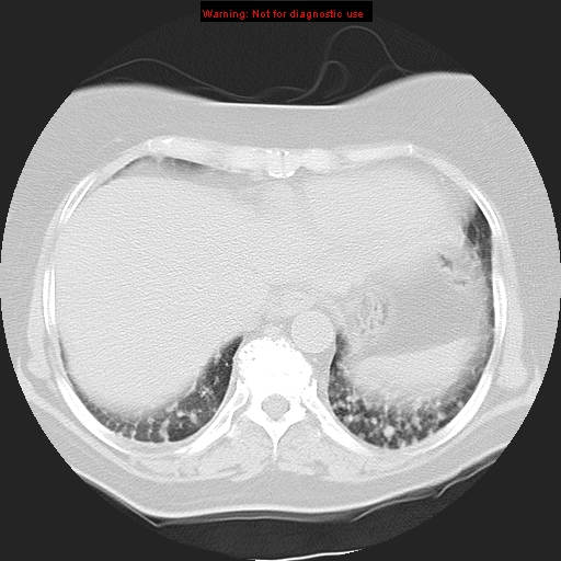 Bronchoalveolar carcinoma (Radiopaedia 13224-13233 Axial lung window 35).jpg