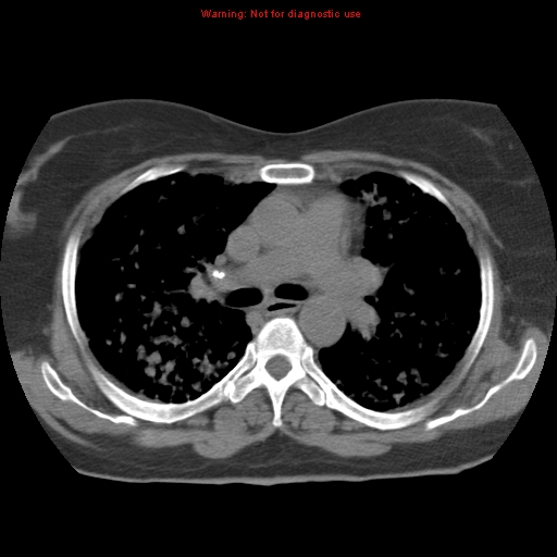 Bronchoalveolar carcinoma (Radiopaedia 13224-13233 Axial non-contrast 19).jpg