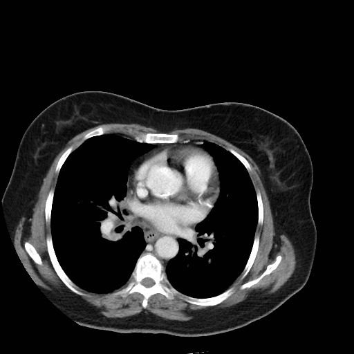 Bronchogenic carcinoma (Radiopaedia 73497-84262 A 37).jpg