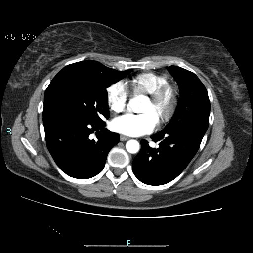 Bronchogenic cyst - posterior mediastinal (Radiopaedia 43885-47364 A 33).jpg
