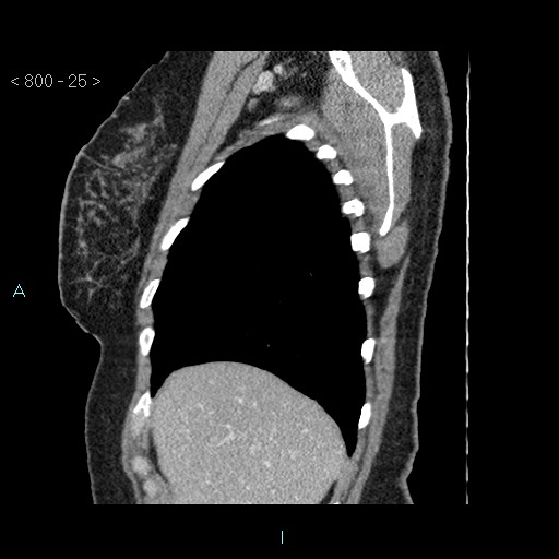 Bronchogenic cyst - posterior mediastinal (Radiopaedia 43885-47364 B 16).jpg