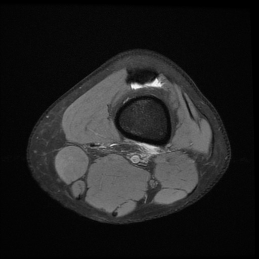 File:Bucket-handle meniscus tear (Radiopaedia 65700-74809 Axial PD fat sat 3).jpg