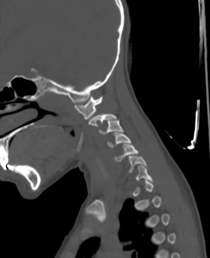 Butterfly vertebra (Radiopaedia 77903-90209 Sagittal bone window 11).jpg