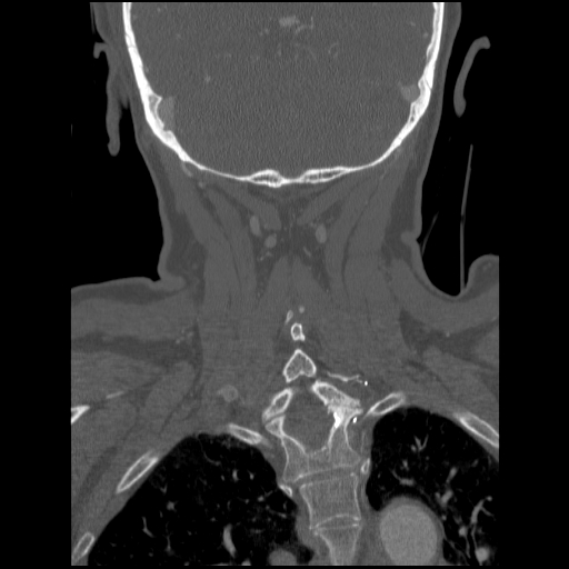 C1 anterior arch (plough) fracture - type 1 (Radiopaedia 76181-87720 Coronal bone window 25).jpg