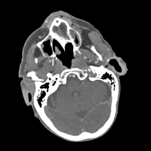 File:C2 fracture with vertebral artery dissection (Radiopaedia 37378-39200 A 204).png