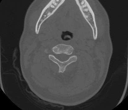 File:C7 laminar fracture and Klippel-Feil syndrome (Radiopaedia 86710-102850 Axial bone window 33).jpg