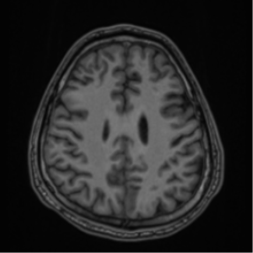CNS vasculitis (Radiopaedia 55715-62263 Axial T1 62).png