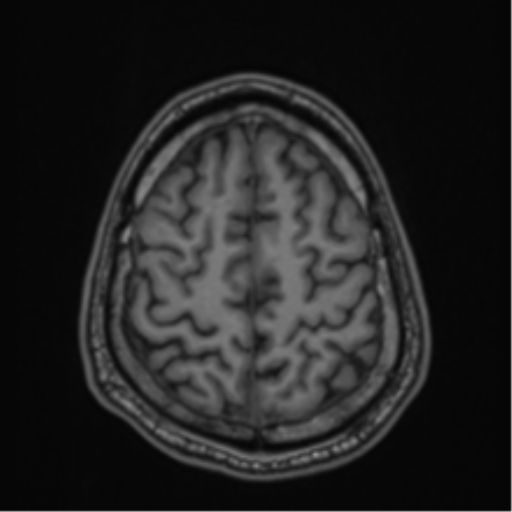 CNS vasculitis (Radiopaedia 55715-62263 Axial T1 80).png