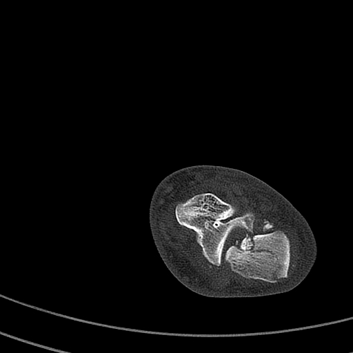 File:Calcaneal fracture - Sanders type 4 (Radiopaedia 90179-107370 Axial bone window 29).jpg