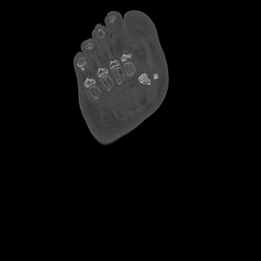 Calcaneal tuberosity avulsion fracture (Radiopaedia 22649-22668 Axial bone window 54).jpg