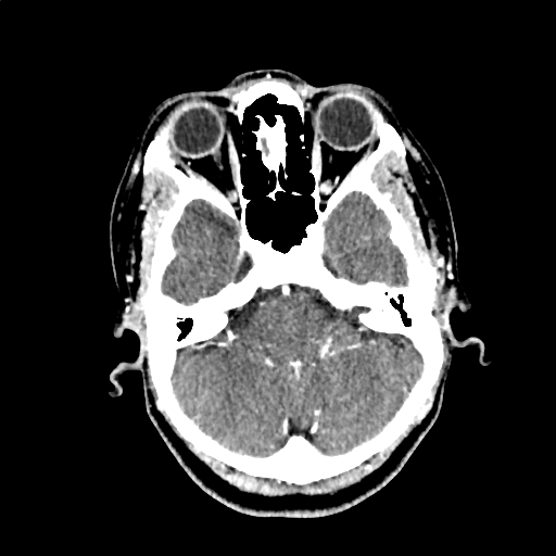 Calcified cerebral hydatid cyst (Radiopaedia 65603-74717 Axial with contrast 12).jpg