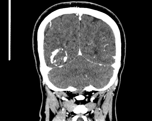 Calcified cerebral hydatid cyst (Radiopaedia 65603-74717 C 59).jpg
