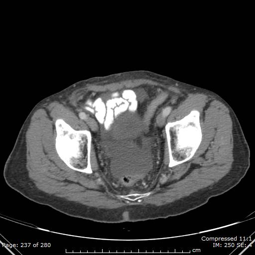 Calcified liver metastases (Radiopaedia 44699-48470 B 55).jpg