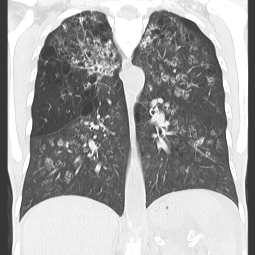 File:Calciphylaxis and metastatic pulmonary calcification (Radiopaedia 10887-11317 C 8).jpg