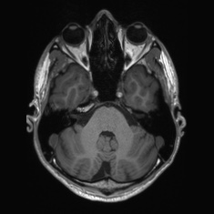 Callosal dysgenesis with interhemispheric cyst (Radiopaedia 53355-59335 Axial T1 39).jpg
