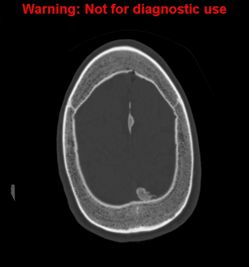 Calvarial thickening from chronic shunting (Radiopaedia 60079-67637 Axial bone window 155).jpg