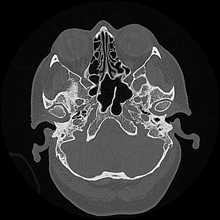 Canal up mastoidectomy (Radiopaedia 78108-90638 Axial bone window 43).jpg