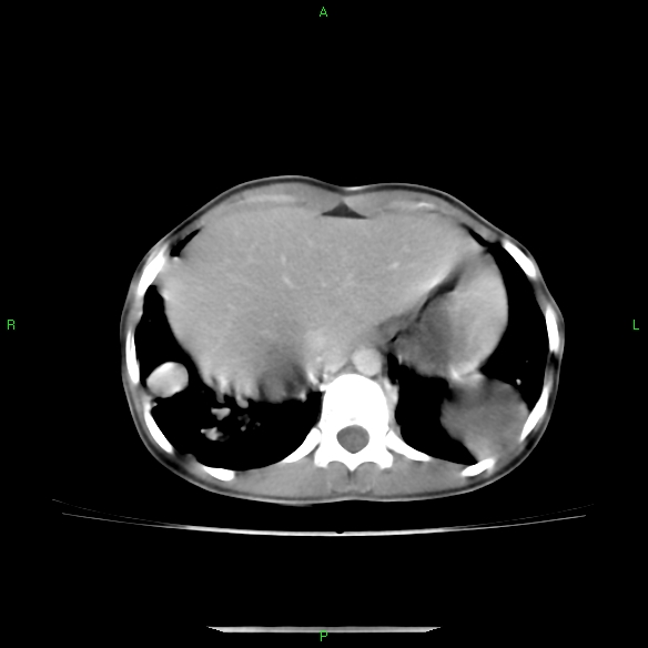 File:Cannon ball metastases - synovial sarcoma (Radiopaedia 26135-26271 C 32).jpg