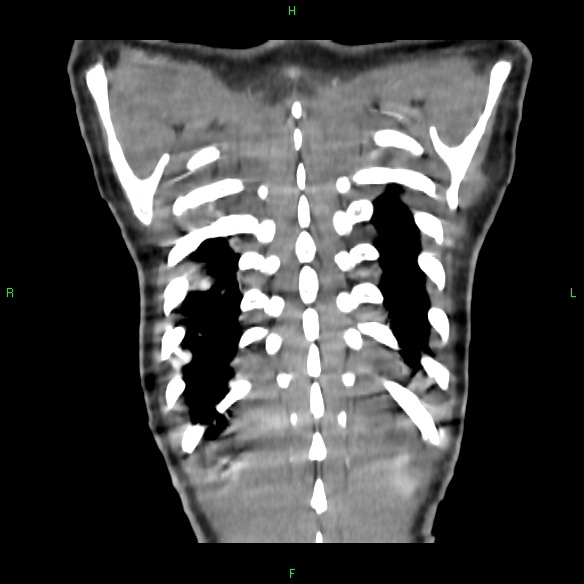 File:Cannon ball metastases - synovial sarcoma (Radiopaedia 26135-26271 Coronal liver window 21).jpg