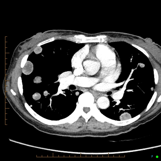 File:Canonball lung metastasis (Radiopaedia 77634-89837 B 47).jpg