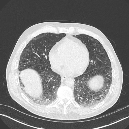 Caplan syndrome (Radiopaedia 56667-63530 Axial lung window 135).jpg