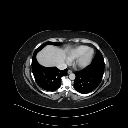 Carcinoid tumor - terminal ileum (Radiopaedia 60931-68739 A 11).jpg