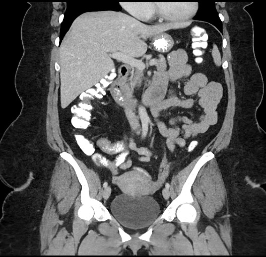 Carcinoid tumor - terminal ileum (Radiopaedia 60931-68739 B 38).jpg