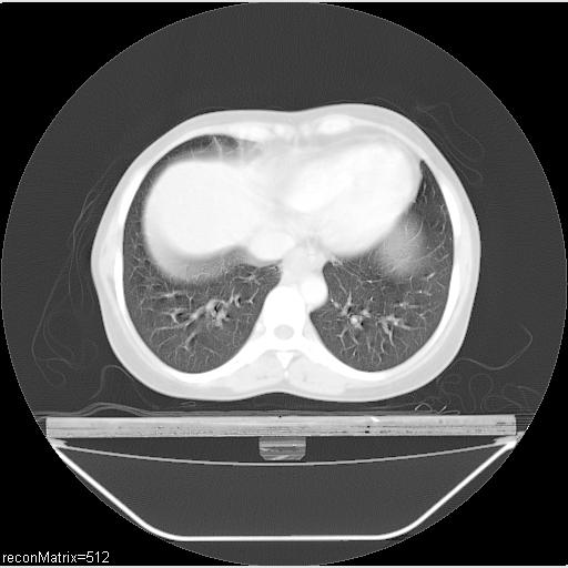 File:Carcinoma of esophagus (Radiopaedia 27356-27550 Axial lung window 11).jpg